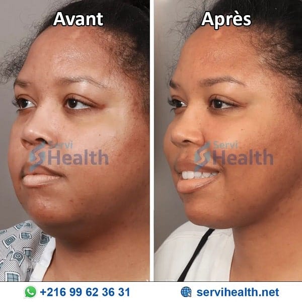 Bichectomie avant après