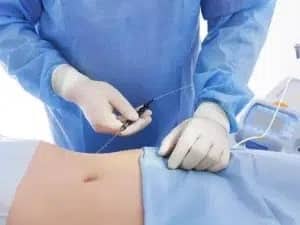 Liposuccion Vaser