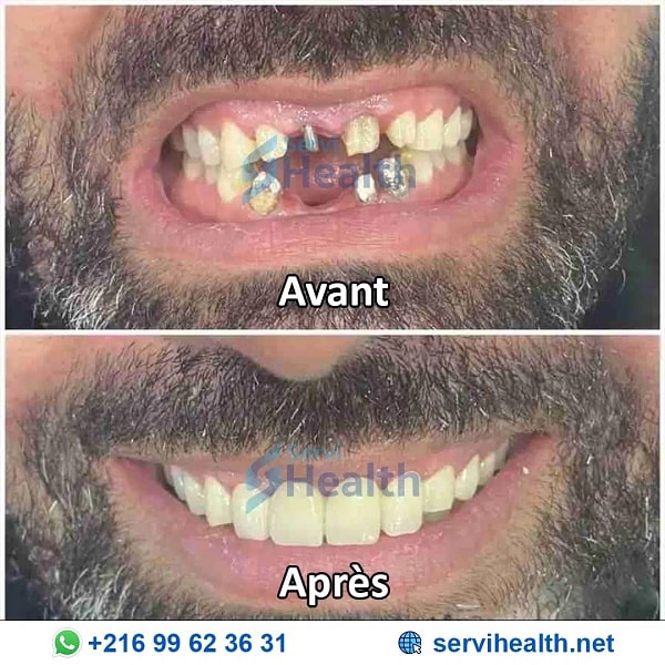 Implants dentaires avant et après