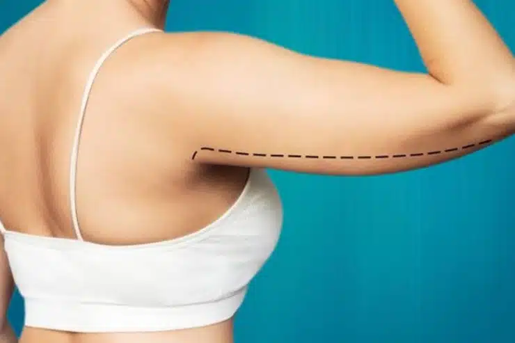 Lifting des Bras
