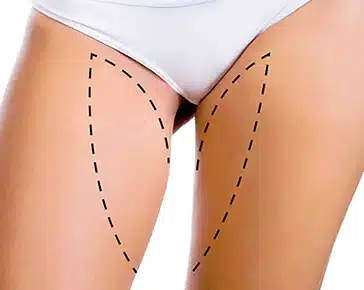 Lifting des cuisses