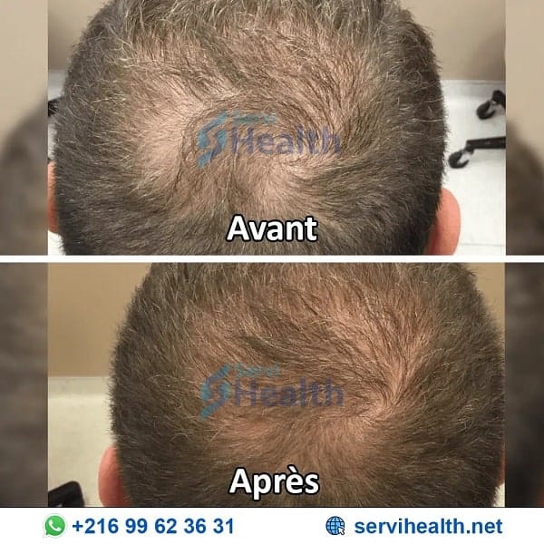 Injection-PRP-avant-apres