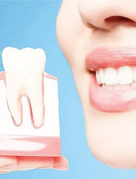implantes dentales
